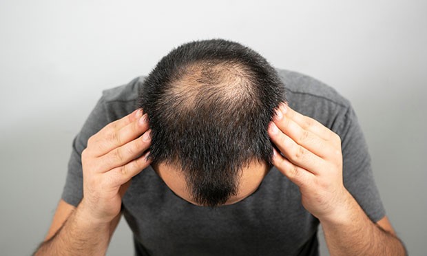 Haaruitval (alopecia androgenetica)